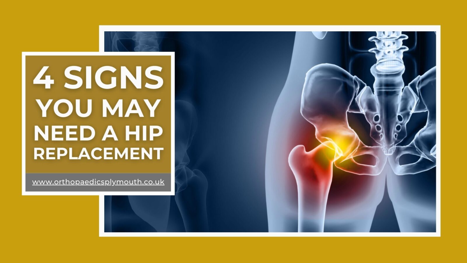 4 Signs You May Need a Hip Replacement