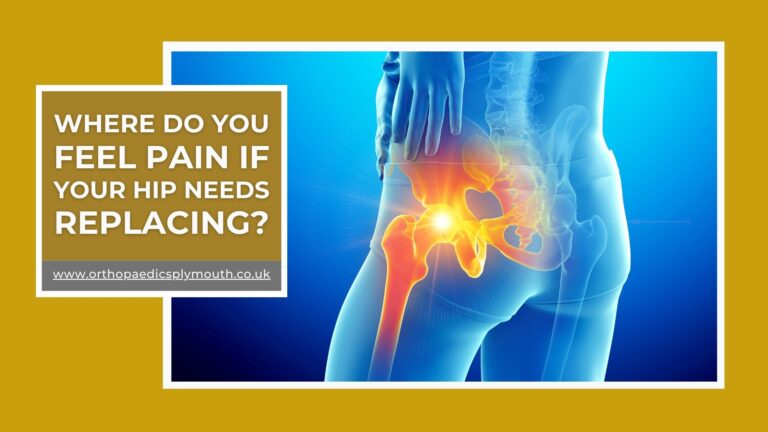 Where Do You Feel Pain If Your Hip Needs Replacing? David Stitson | Orthopaedic Surgeon | The Nuffield Plymouth