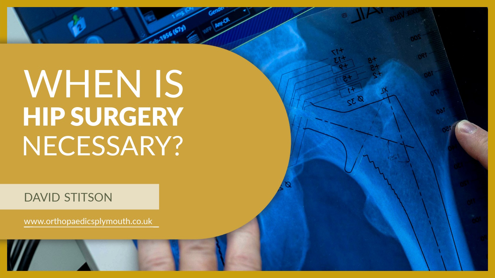 When Is Hip Surgery Necessary | David Stitson Orthopaedic Surgeon | Plymouth