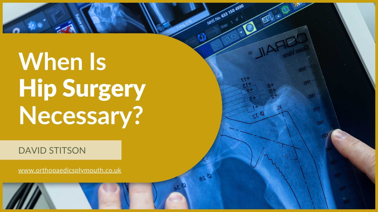 When Is Hip Surgery Necessary