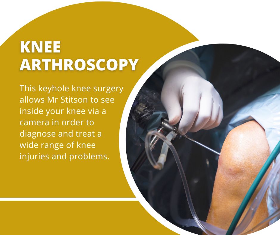 knee arthroscopy provides a quicker and more efficient route to recovery compared to traditional surgery, enabling those affected to return to their daily activities with greater ease and confidence.