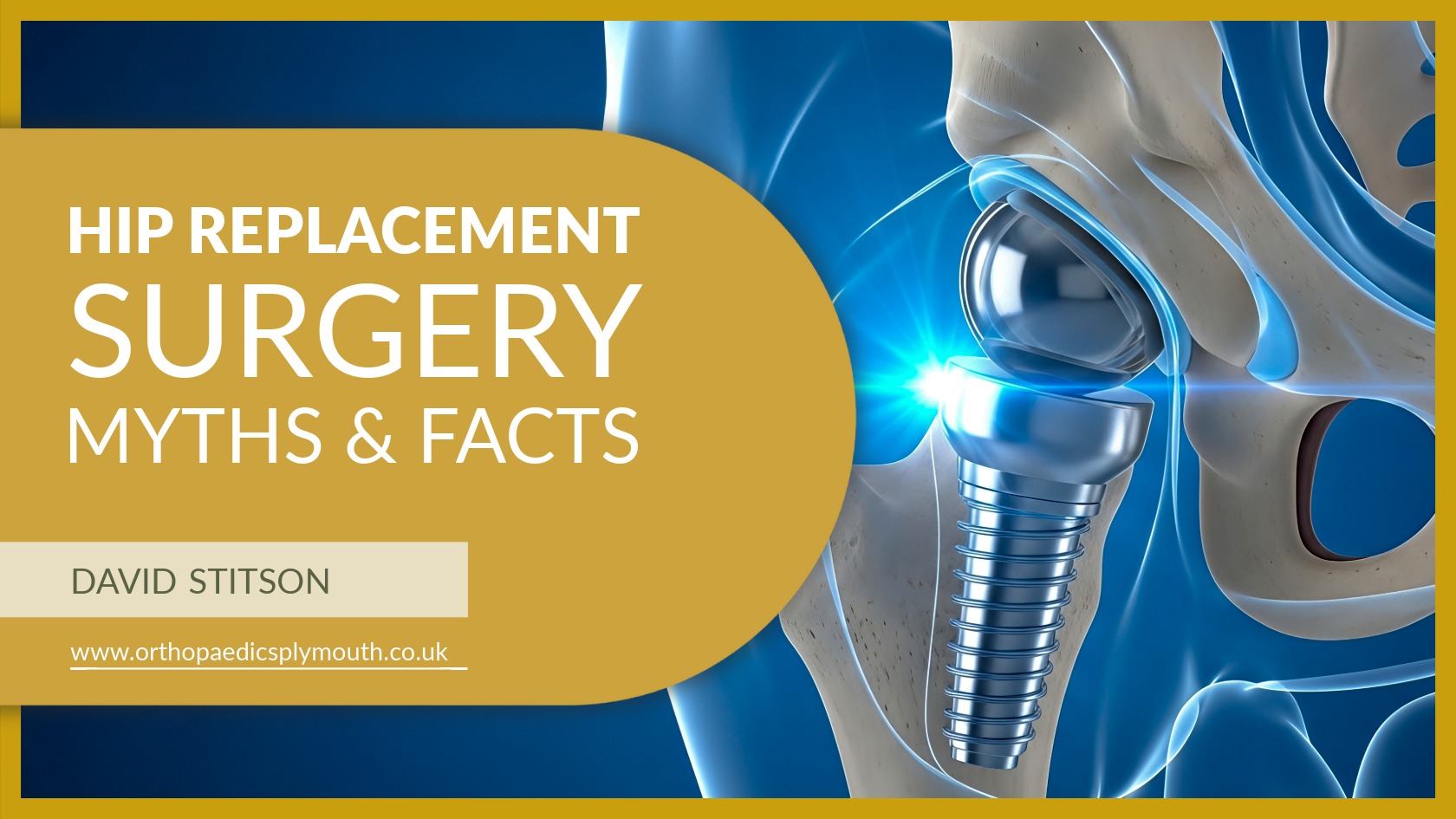 Hip Replacement Surgery Myths & Facts | David Stitson | Consultant Orthopaedic Surgeon | Plymouth.