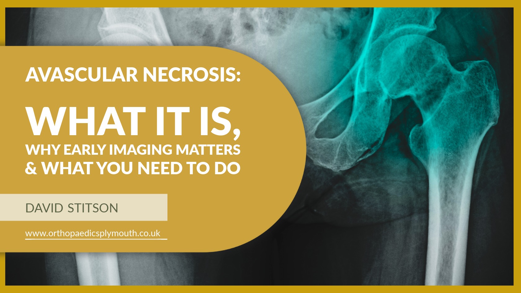 Avascular Necrosis: What It Is & What You Need To Do | Mr David Stitson | CONSULTANT ORTHOPAEDIC SURGEON | Plymouth Avascular Necrosis: What It Is, why early imaging matters & What You Need To Do | David Stitson, Consultant Orthopaedic Surgeon in Plymouth.