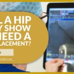 Will a Hip X-Ray Show If I Need a Hip Replacement? | David Stitson, Consultant Orthopaedic Surgeon in Plymouth.