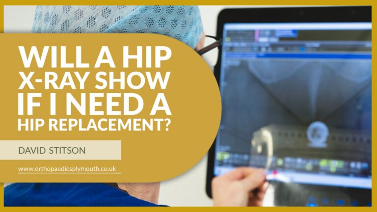 Will a Hip X-Ray Show If I Need a Hip Replacement? | David Stitson, Consultant Orthopaedic Surgeon in Plymouth.