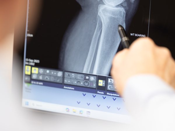 Is your Knee Locking, Catching, or Buckling? Here's What It Could Mean | David Stitson, Consultant Orthopaedic Surgeon in Plymouth.